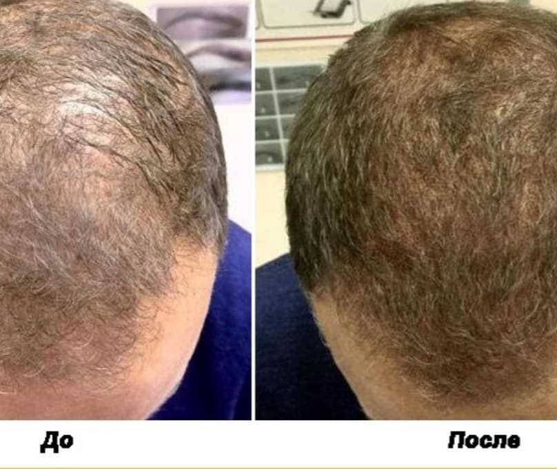 Хаир тату (hair tattoo) на затылке женские. фото короткие, звезда, крылья для девушек
