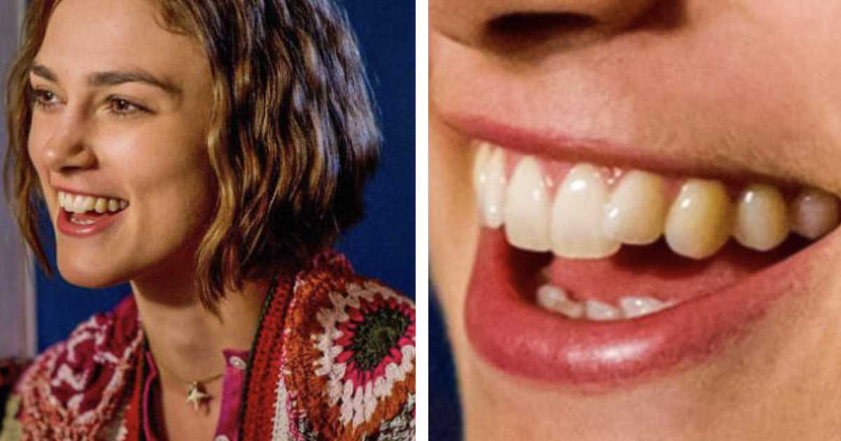 Голливудские улыбки фото – голливудская улыбка – как делают, стоимость, фото до и после – доктор зуб